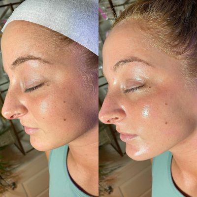 resultat-hydrafacial-2