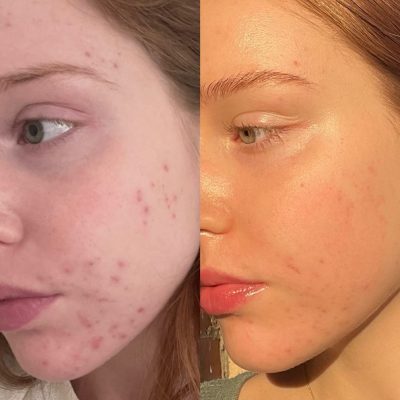 resultat-hydrafacial-3