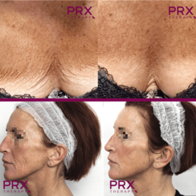 resultat-micropeeling resultat-micropeeling