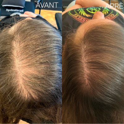 Hydrafacial-keravive-avant-apres Hydrafacial-keravive-avant-apres