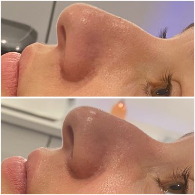 resultat-hydrafacial-1