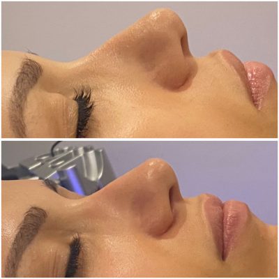 resultat-hydrafacial-2