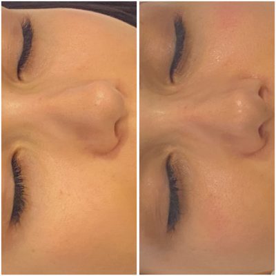 resultat-hydrafacial-3