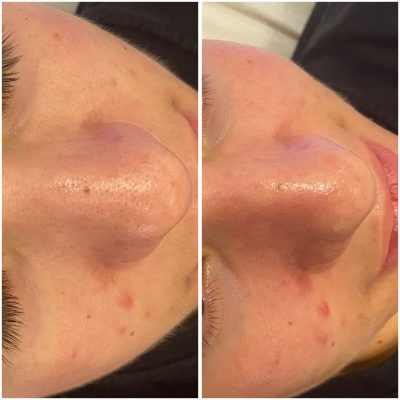 resultat-hydrafacial-3